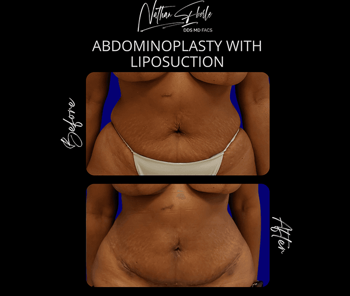Liposuction before and after case 65, actual patient at Weston Center for Plastic Surgery