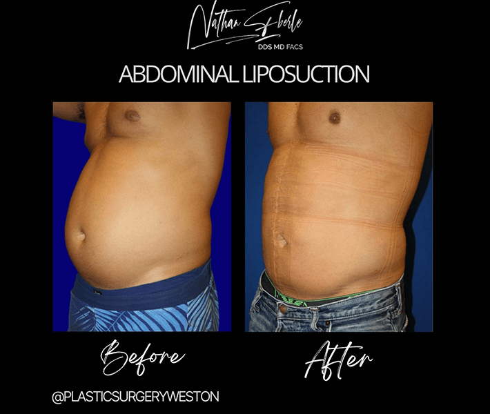 Liposuction before and after case 66, actual patient at Weston Center for Plastic Surgery