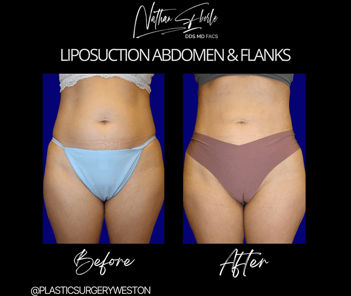 Liposuction before and after case 68, actual patient at Weston Center for Plastic Surgery