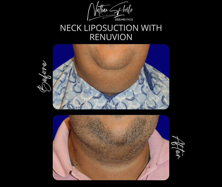 Liposuction before and after case 69, actual patient at Weston Center for Plastic Surgery