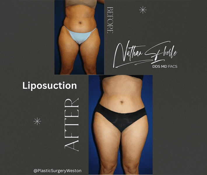 Liposuction before and after case 7, actual patient at Weston Center for Plastic Surgery