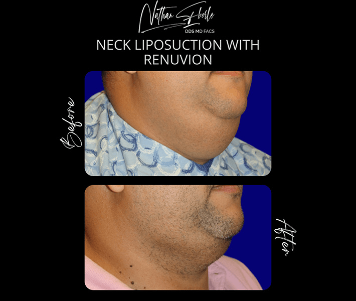 Liposuction before and after case 70, actual patient at Weston Center for Plastic Surgery