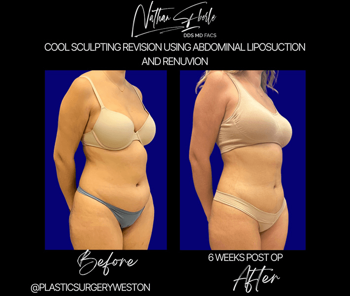 Liposuction before and after case 71, actual patient at Weston Center for Plastic Surgery