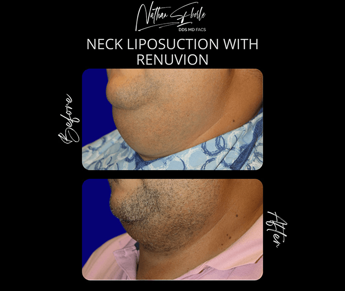 Liposuction before and after case 73, actual patient at Weston Center for Plastic Surgery