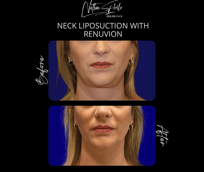 Liposuction before and after case 74, actual patient at Weston Center for Plastic Surgery