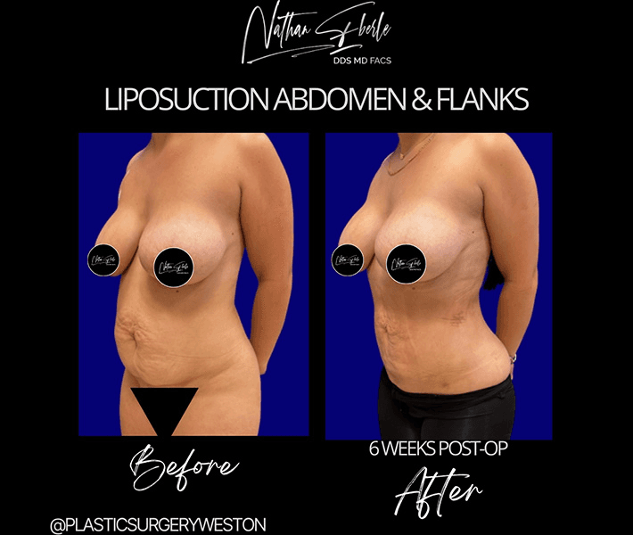 Liposuction before and after case 75, actual patient at Weston Center for Plastic Surgery