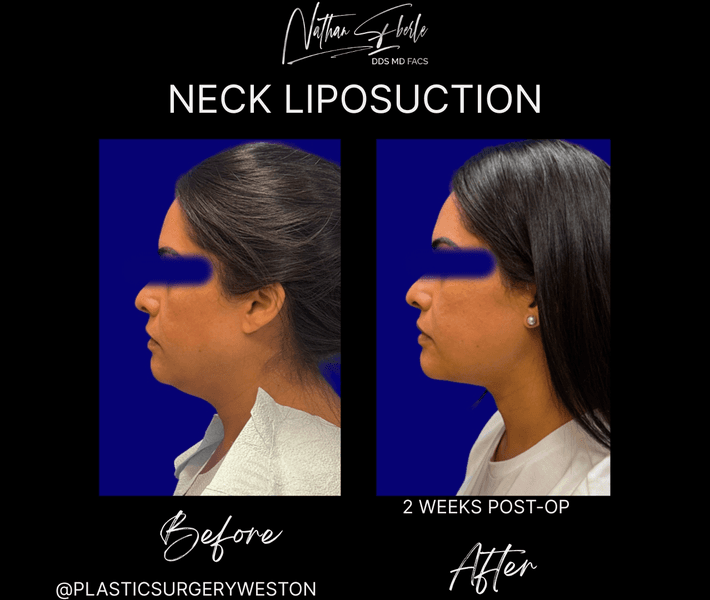 Liposuction case 78 before and after results at Weston Center for Plastic Surgery