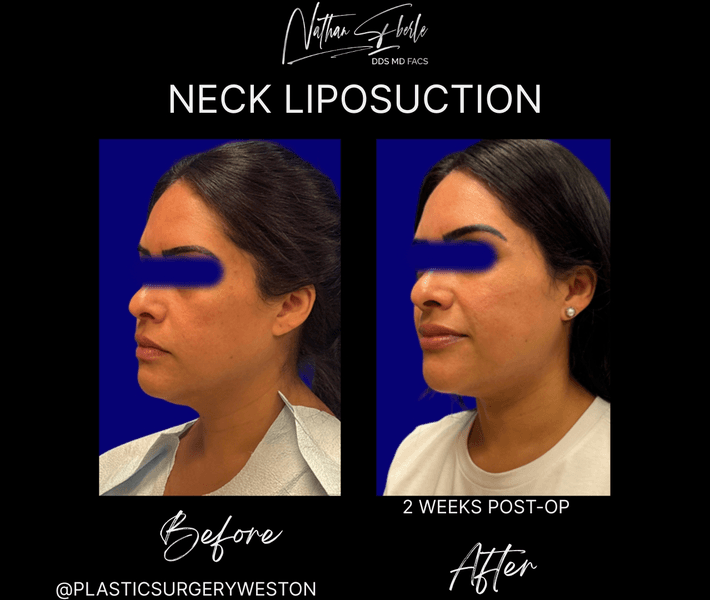 Liposuction case 79 before and after results at Weston Center for Plastic Surgery