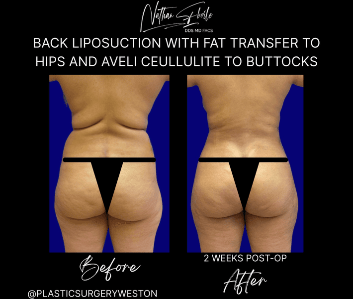 Liposuction case 80 before and after results at Weston Center for Plastic Surgery