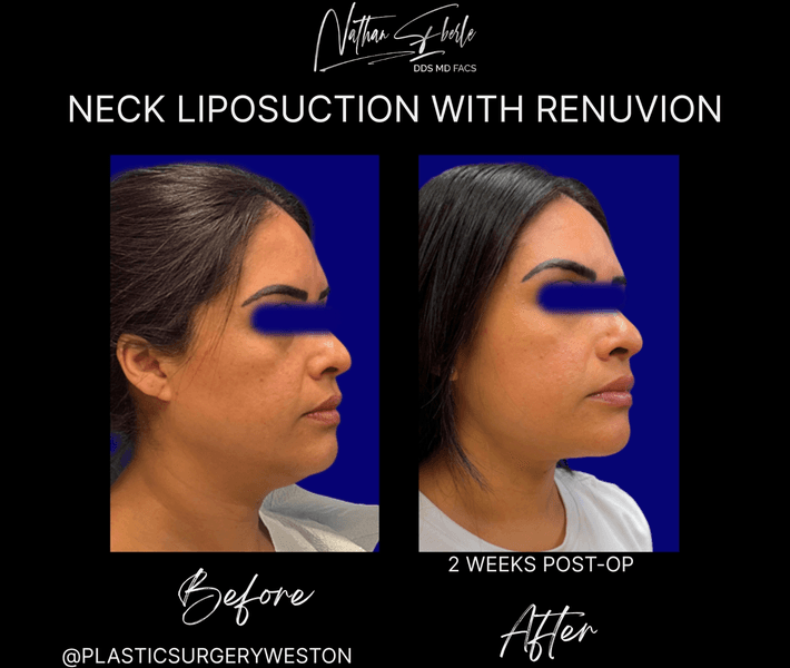 Liposuction case 81 before and after results at Weston Center for Plastic Surgery
