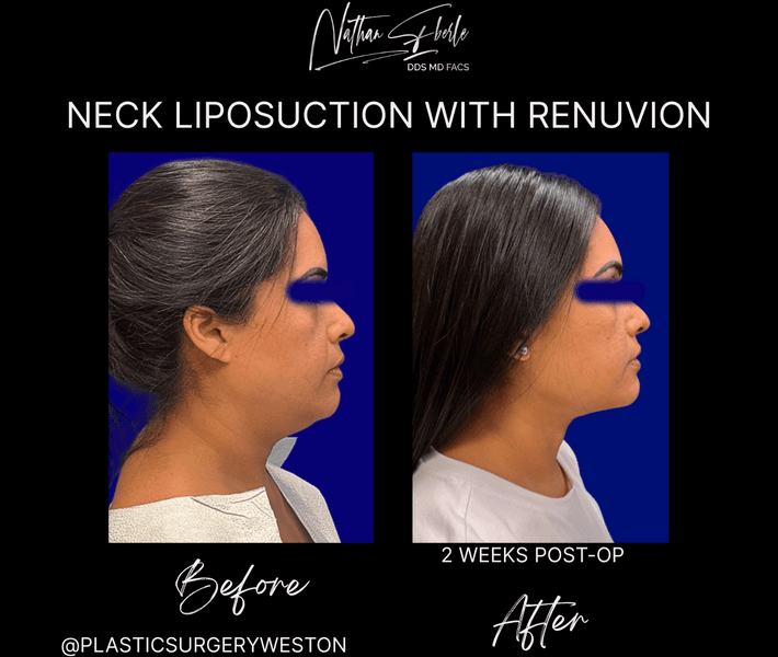 Liposuction case 82 before and after results at Weston Center for Plastic Surgery