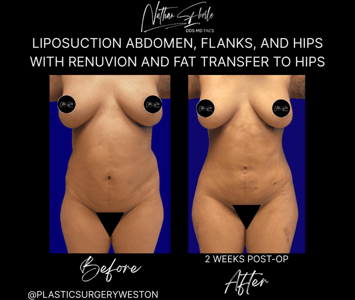 Liposuction case 83 before and after results at Weston Center for Plastic Surgery