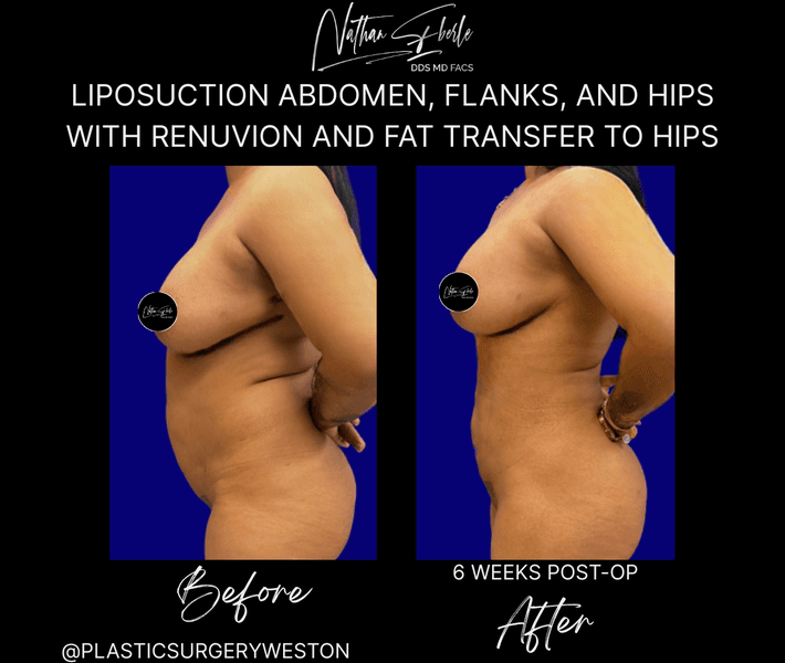 Liposuction case 84 before and after results at Weston Center for Plastic Surgery