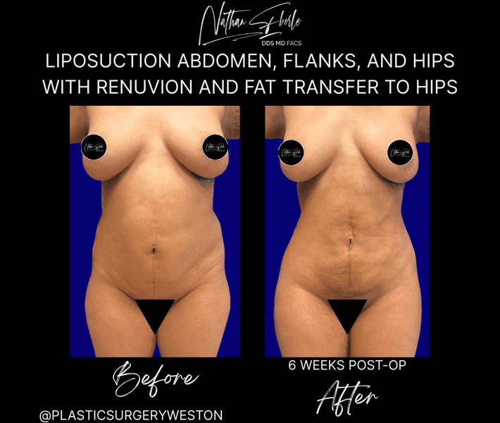 Liposuction case 85 before and after results at Weston Center for Plastic Surgery