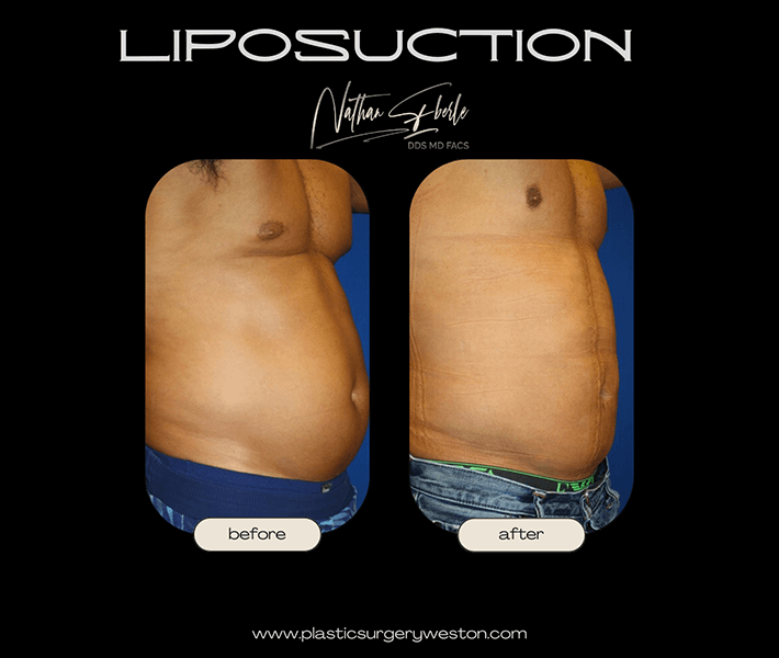 Liposuction before and after case 9, actual patient at Weston Center for Plastic Surgery