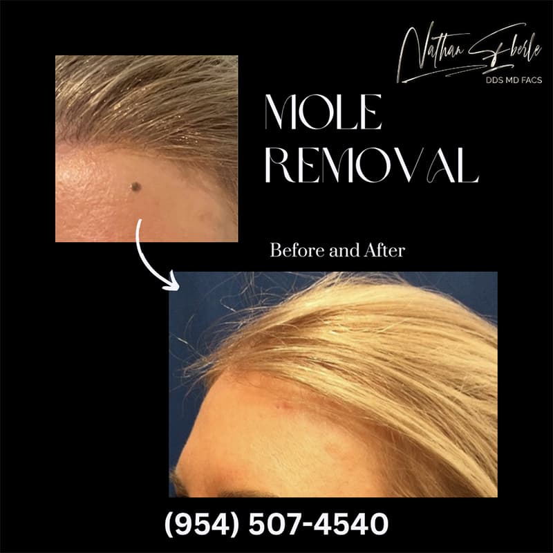 Mole Removal before and after case 1, actual patient at Weston Center for Plastic Surgery