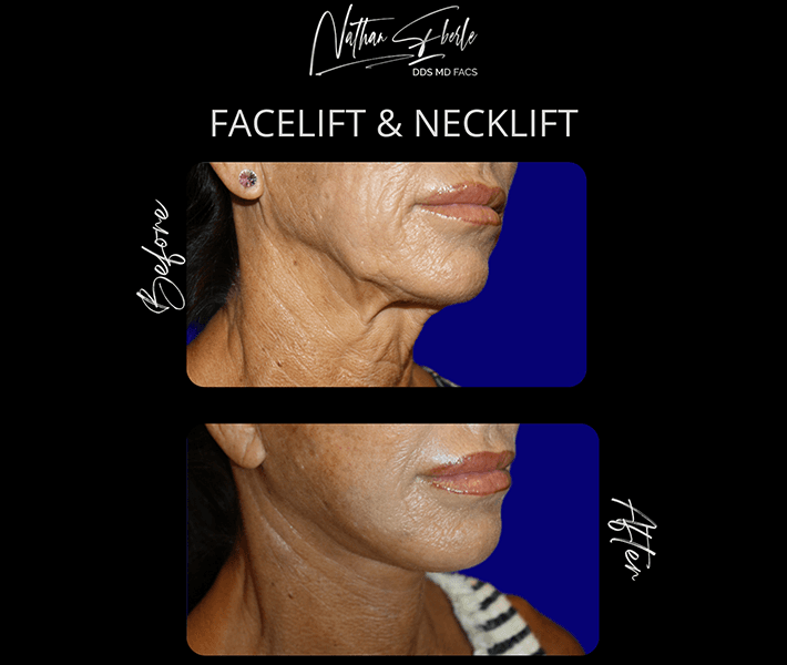 Neck Lift before and after case 11, actual patient at Weston Center for Plastic Surgery