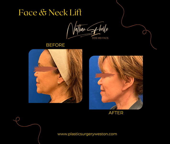 Neck Lift before and after case 14, actual patient at Weston Center for Plastic Surgery