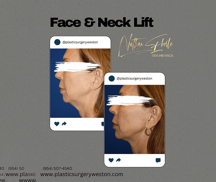 Neck Lift before and after case 16, actual patient at Weston Center for Plastic Surgery