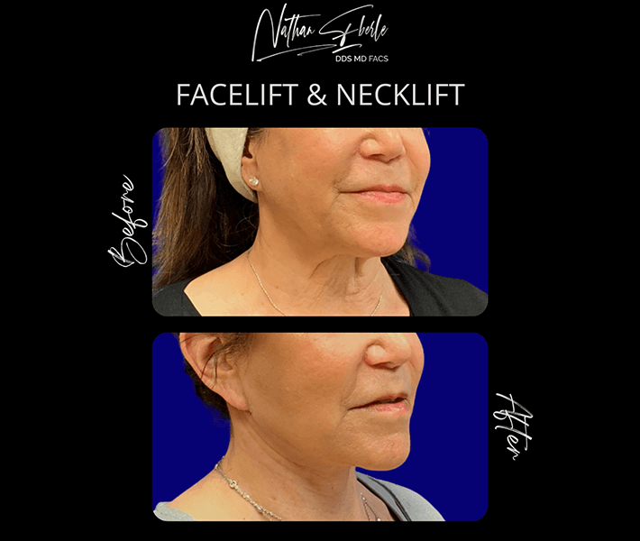 Neck Lift before and after case 18, actual patient at Weston Center for Plastic Surgery