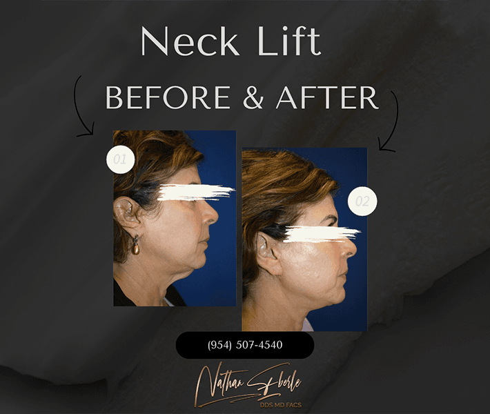 Neck Lift before and after case 19, actual patient at Weston Center for Plastic Surgery