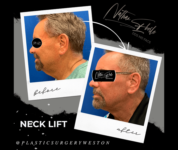 Neck Lift before and after case 20, actual patient at Weston Center for Plastic Surgery