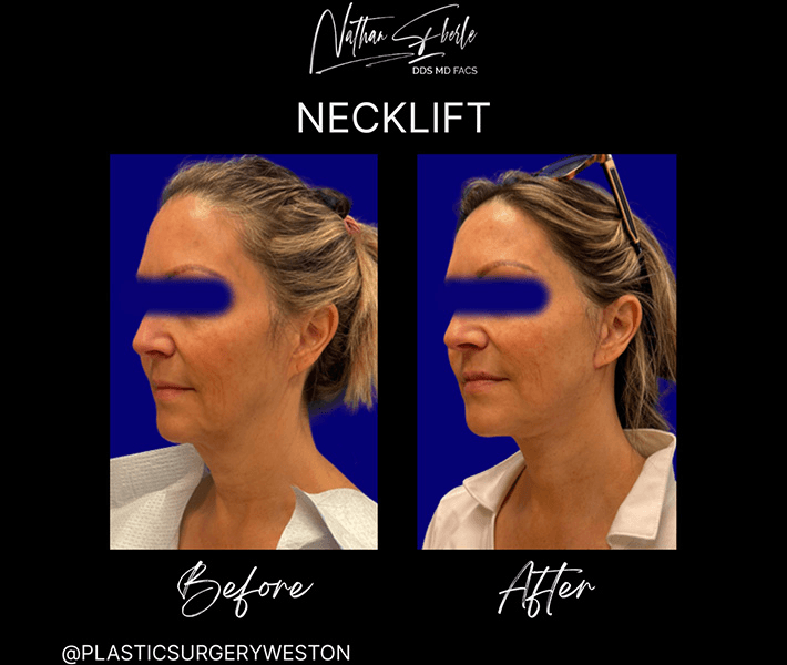 Neck Lift before and after case 21, actual patient at Weston Center for Plastic Surgery