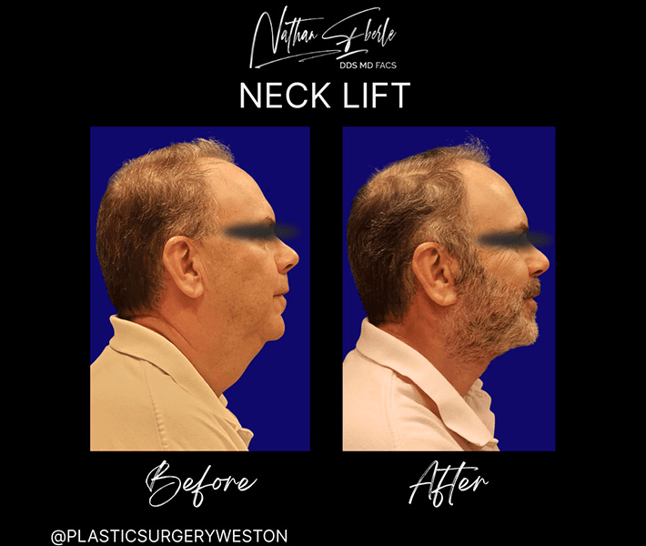 Neck Lift before and after case 23, actual patient at Weston Center for Plastic Surgery