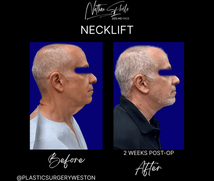 Neck Lift case 24 before and after results at Weston Center for Plastic Surgery
