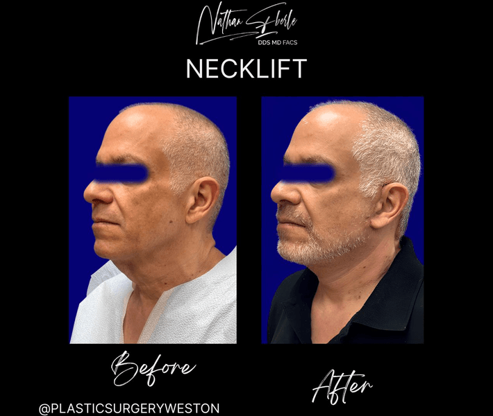 Neck Lift case 25 before and after results at Weston Center for Plastic Surgery