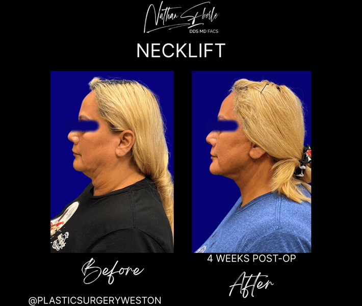 Neck Lift case 26 before and after results at Weston Center for Plastic Surgery