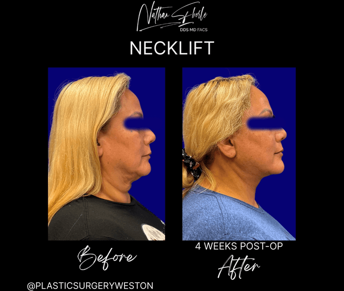 Neck Lift case 27 before and after results at Weston Center for Plastic Surgery