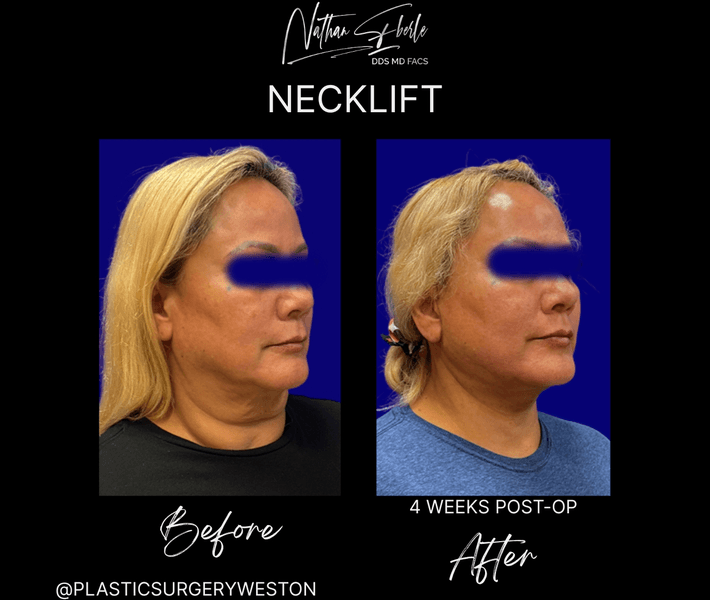 Neck Lift case 28 before and after results at Weston Center for Plastic Surgery