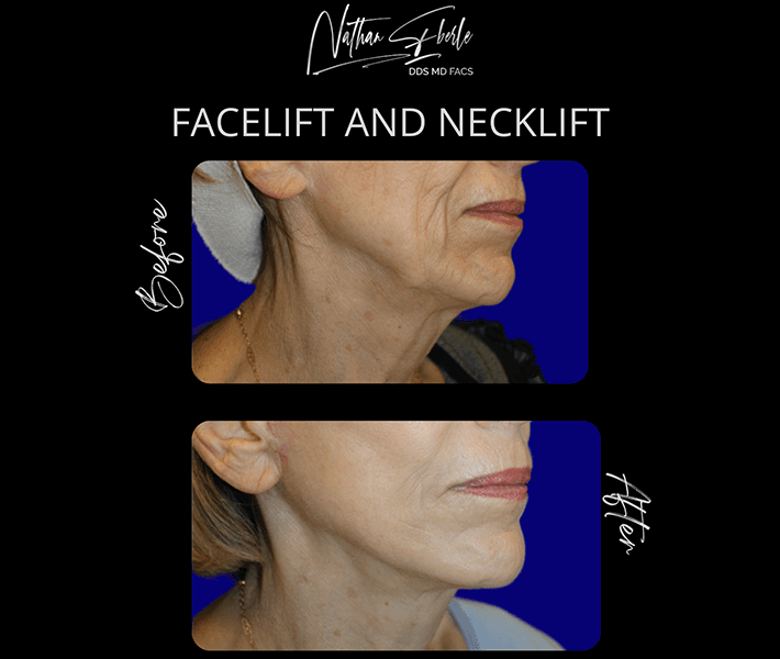 Neck Lift before and after case 4, actual patient at Weston Center for Plastic Surgery
