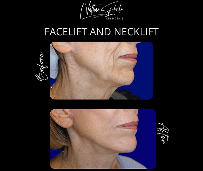 Neck Lift before and after case 6, actual patient at Weston Center for Plastic Surgery