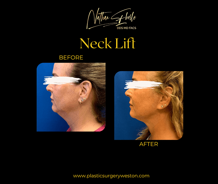 Neck Lift before and after case 7, actual patient at Weston Center for Plastic Surgery