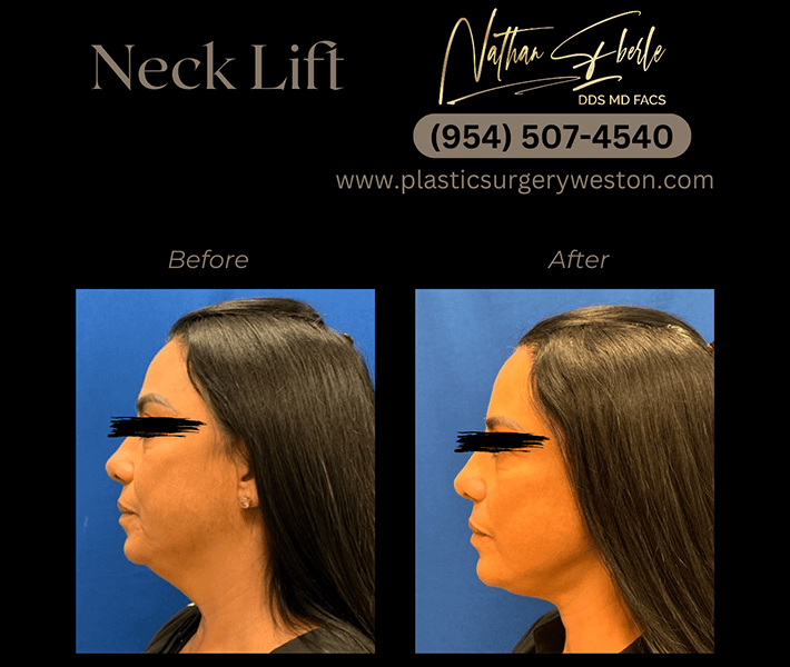 Neck Lift before and after case 8, actual patient at Weston Center for Plastic Surgery