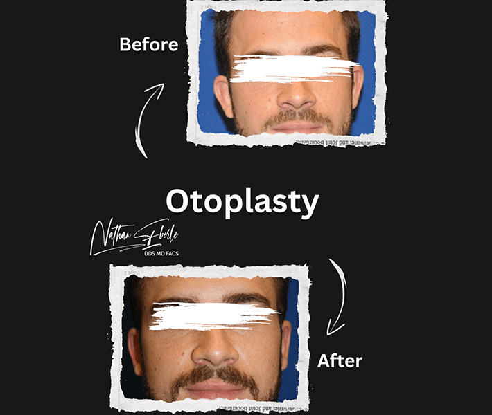 Otoplasty before and after case 11, actual patient at Weston Center for Plastic Surgery