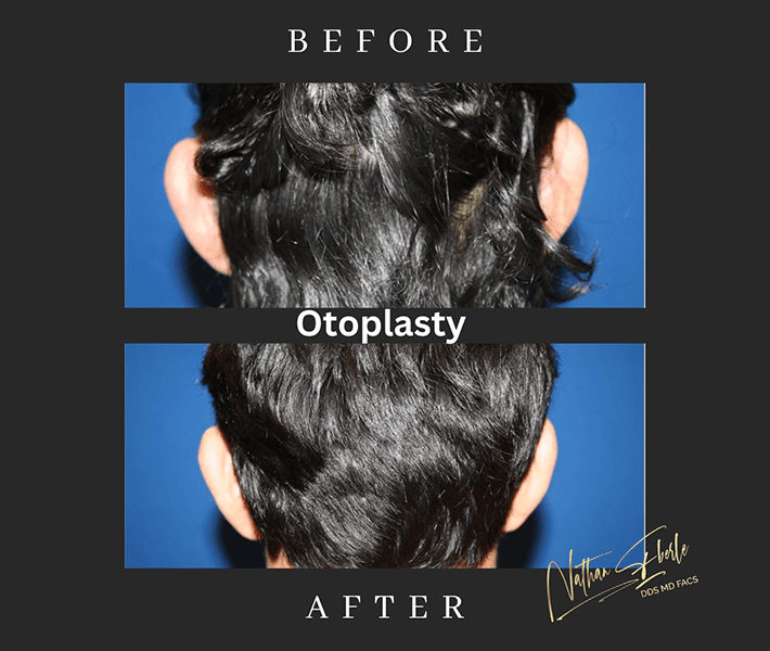 Otoplasty before and after case 12, actual patient at Weston Center for Plastic Surgery