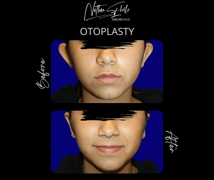 Otoplasty before and after case 13, actual patient at Weston Center for Plastic Surgery