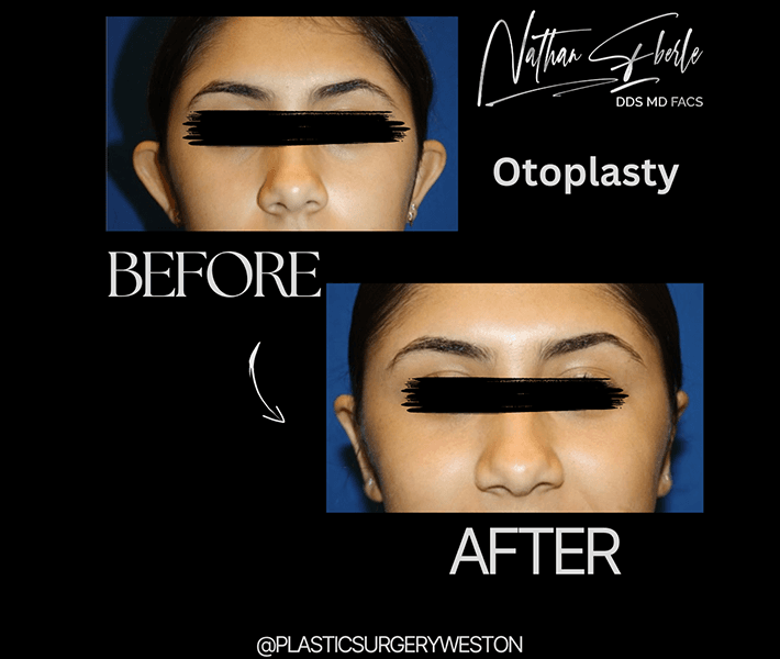 Otoplasty before and after case 14, actual patient at Weston Center for Plastic Surgery