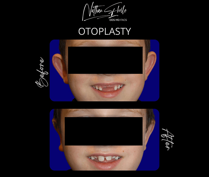 Otoplasty before and after case 15, actual patient at Weston Center for Plastic Surgery