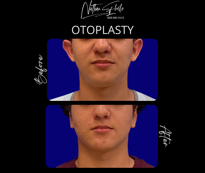 Otoplasty before and after case 16, actual patient at Weston Center for Plastic Surgery