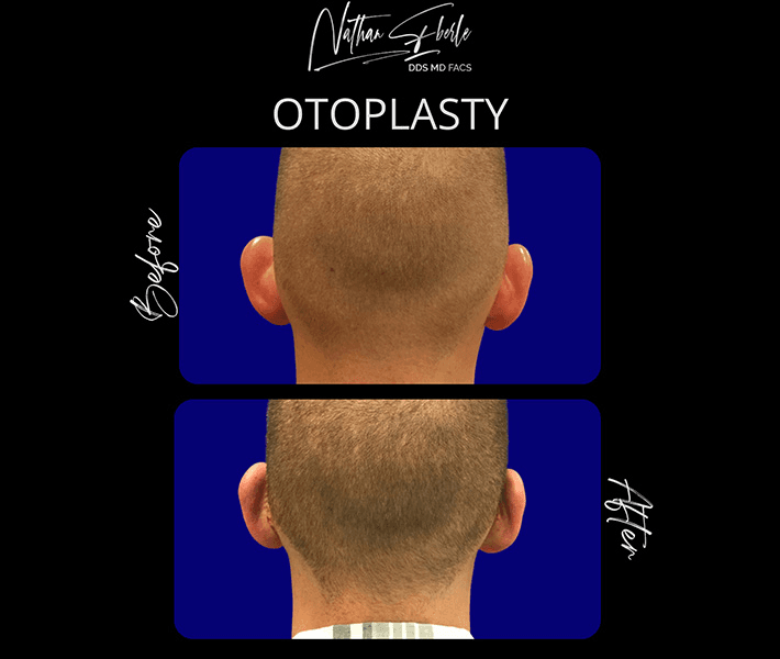 Otoplasty before and after case 17, actual patient at Weston Center for Plastic Surgery