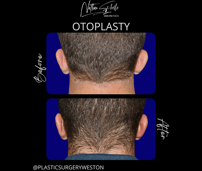 Otoplasty before and after case 18, actual patient at Weston Center for Plastic Surgery