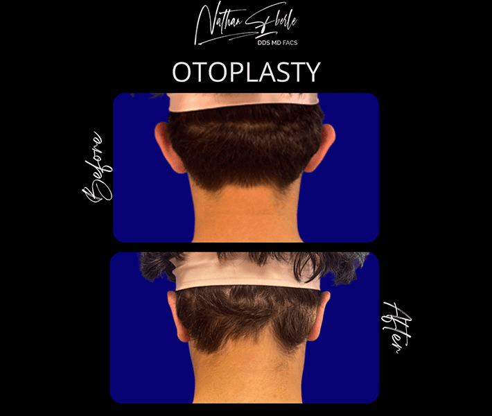 Otoplasty before and after case 19, actual patient at Weston Center for Plastic Surgery