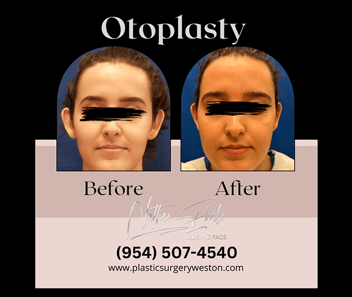 Otoplasty before and after case 2, actual patient at Weston Center for Plastic Surgery