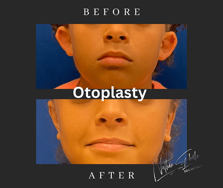 Otoplasty before and after case 3, actual patient at Weston Center for Plastic Surgery