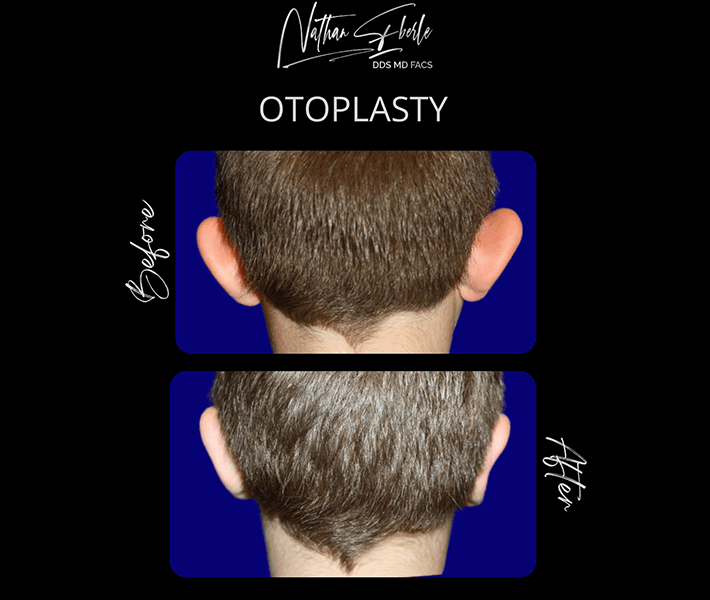 Otoplasty before and after case 4, actual patient at Weston Center for Plastic Surgery