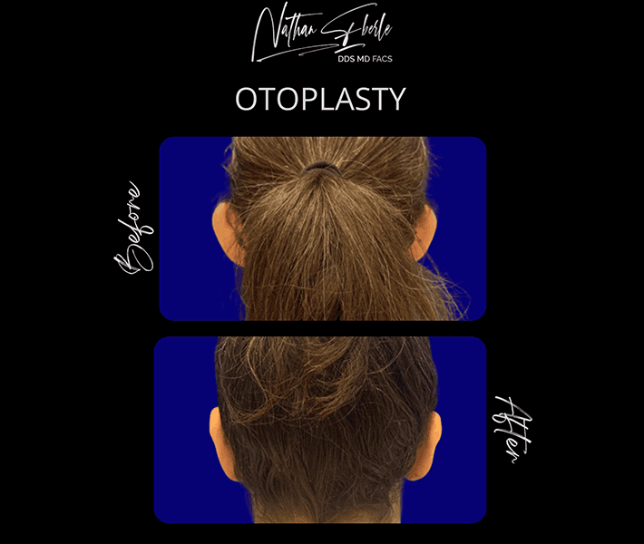 Otoplasty before and after case 5, actual patient at Weston Center for Plastic Surgery